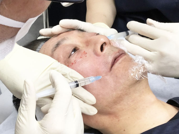 表面麻酔を施し線維芽細胞を注入します