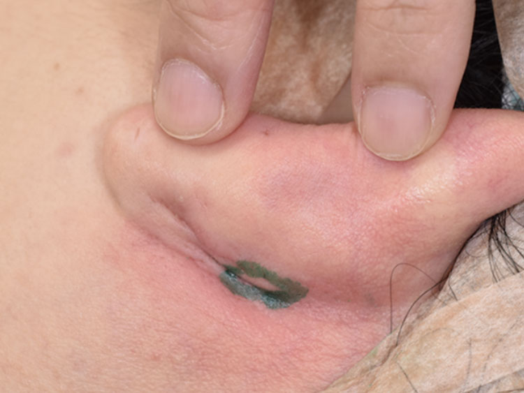 耳介の裏から皮膚を採取します