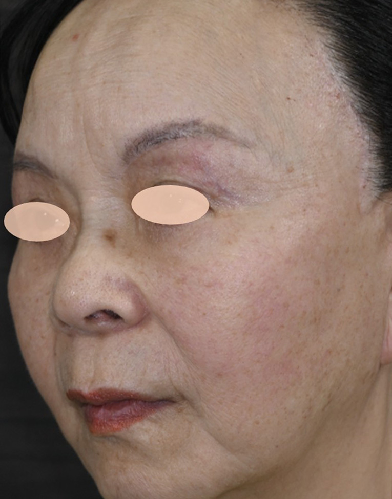 症例写真2